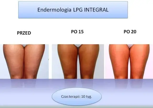 mapa zabiegów endermologii na ciało
