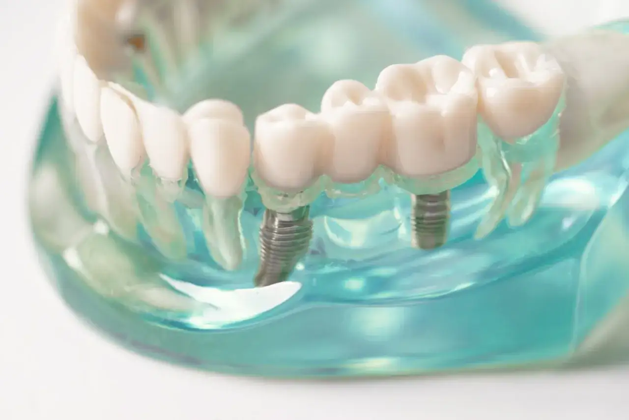 Model szczęki z implantami zębowymi. Zastanawiasz się, ile kosztuje wstawienie zęba?