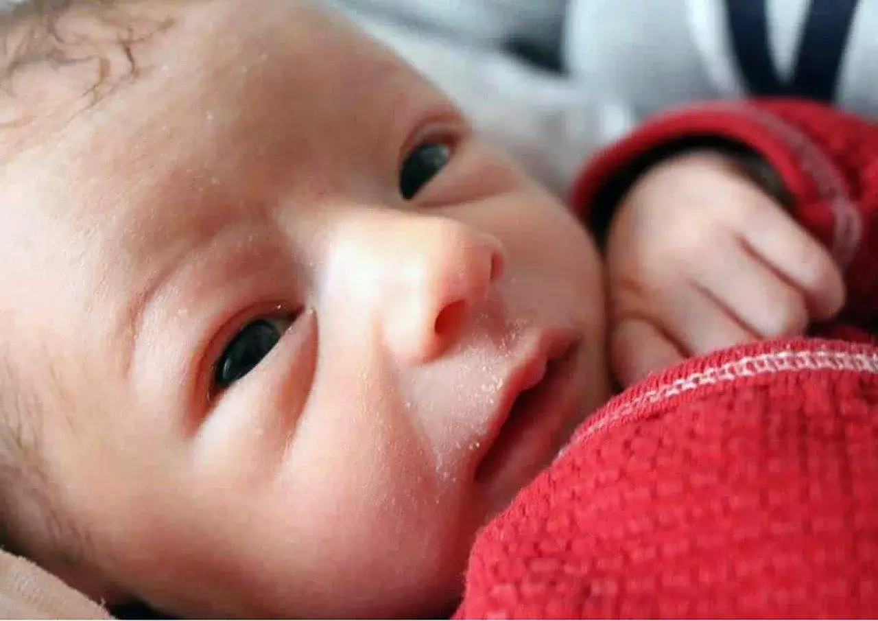 Primo piano del viso di un neonato con crosta lattea. La sua manina &egrave; appoggiata su una coperta rossa.