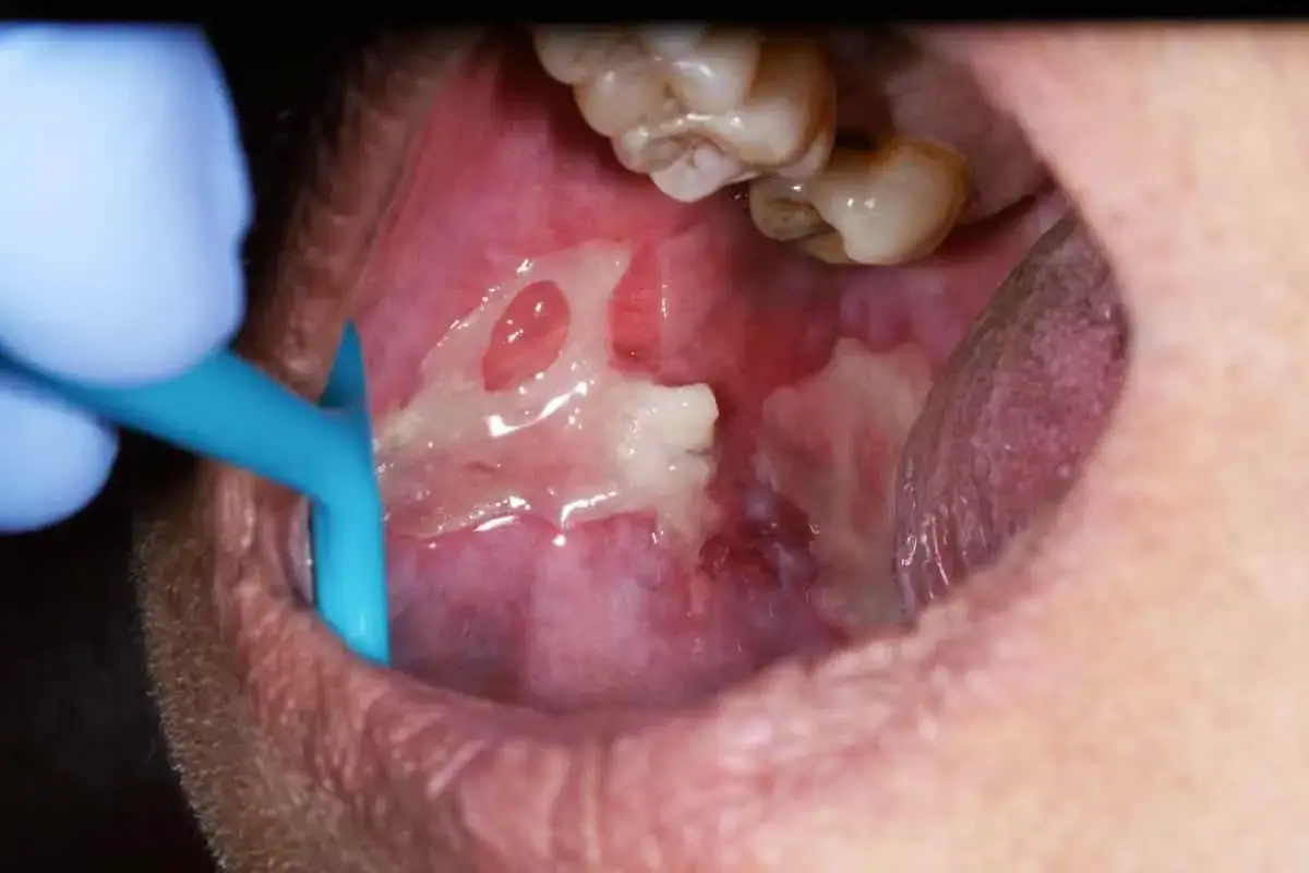 Bulto en mejilla interna con úlceras y tejido inflamado. Un instrumento azul examina la zona.
