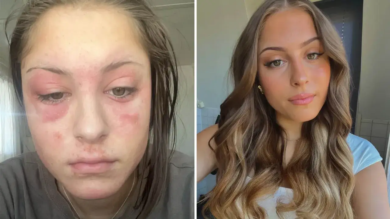 Före och efter-bilder visar en ung kvinna med svåra blåsor i ansiktet, som sedan återhämtat sig till en klar hy.