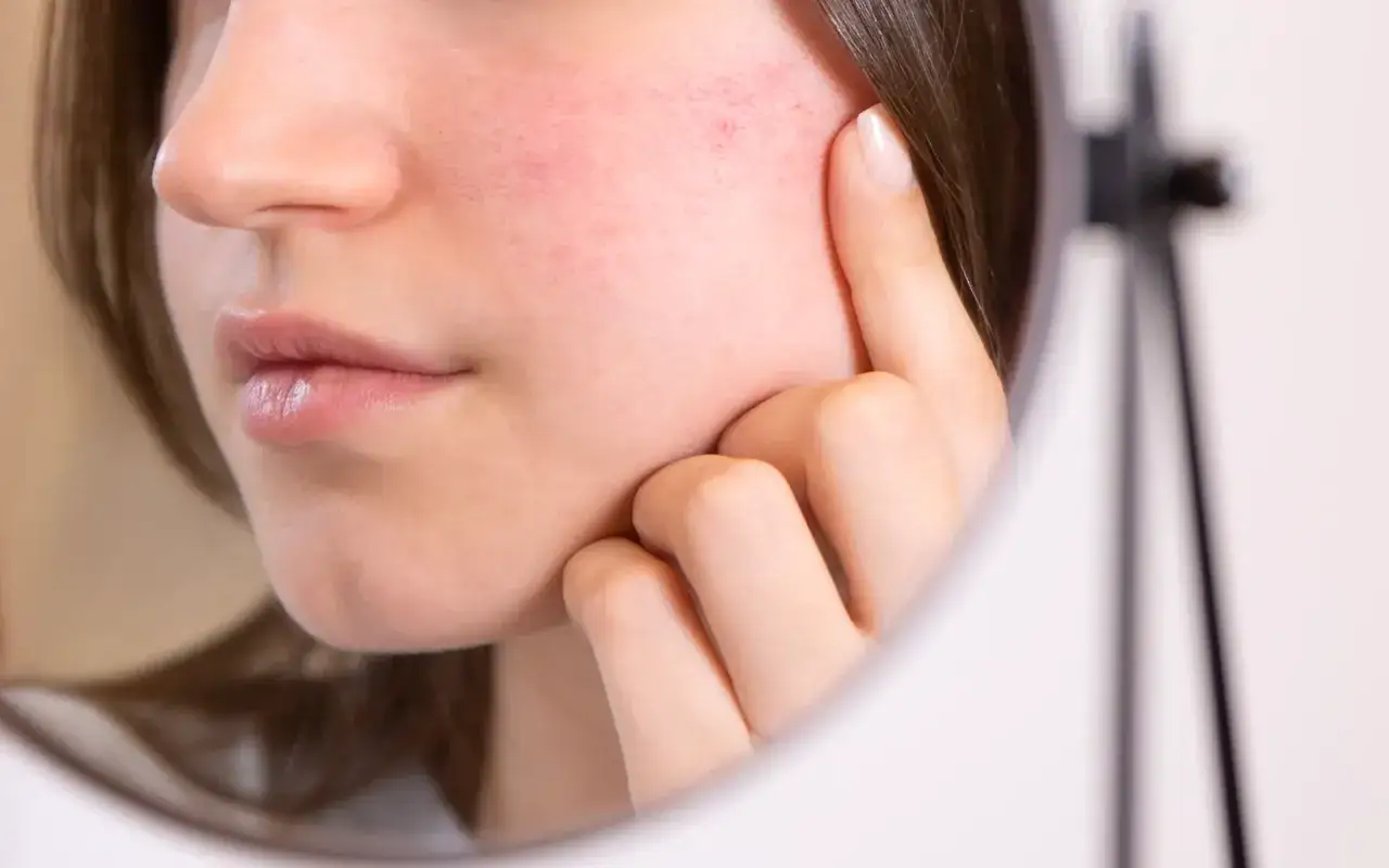Une jeune femme examine son visage dans un miroir, révélant des rougeurs sur ses joues, un symptôme de peau sensible.