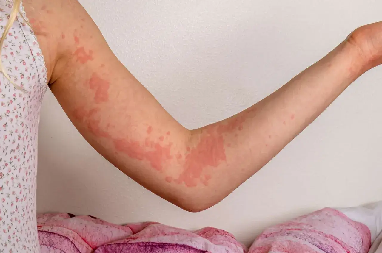 Bras d'enfant couvert de plaques rouges et de boutons allergie, signe d'une réaction cutanée.