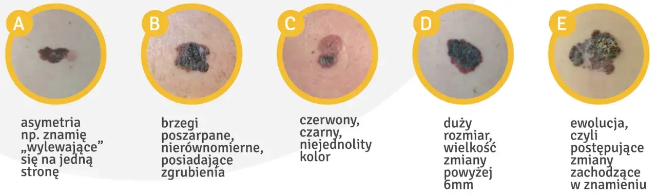 Zasada ABCDE czerniak