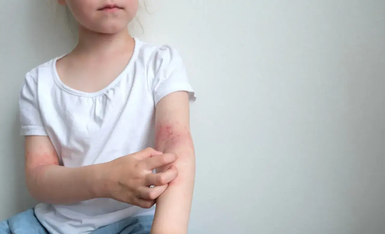 Bambino con psoriasi sul gomito, la pelle arrossata e irritata.