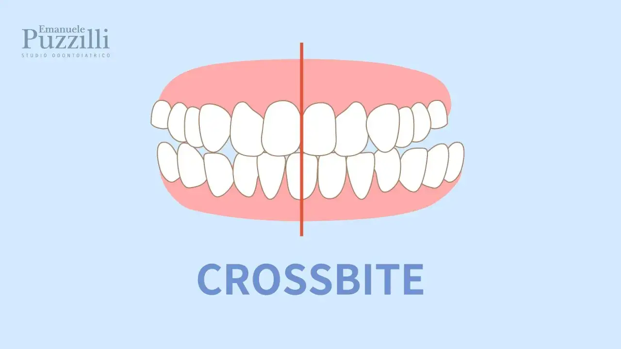 Illustrazione di un morso incrociato, dove i denti superiori non si allineano correttamente con quelli inferiori.