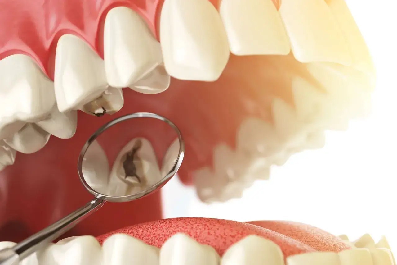 Widok zęba z próchnicą i wypełnieniem, widoczne przez lusterko dentystyczne. Trutka w zębie 2 miesiące.