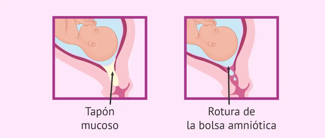 Ilustraci&oacute;n comparativa: tap&oacute;n mucoso y rotura de la bolsa amni&oacute;tica. Se puede cerrar una fisura de bolsa.