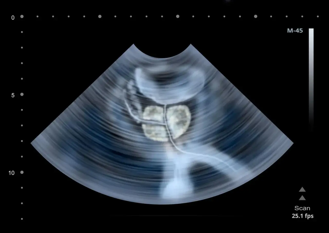 badanie prostaty per rectum schemat