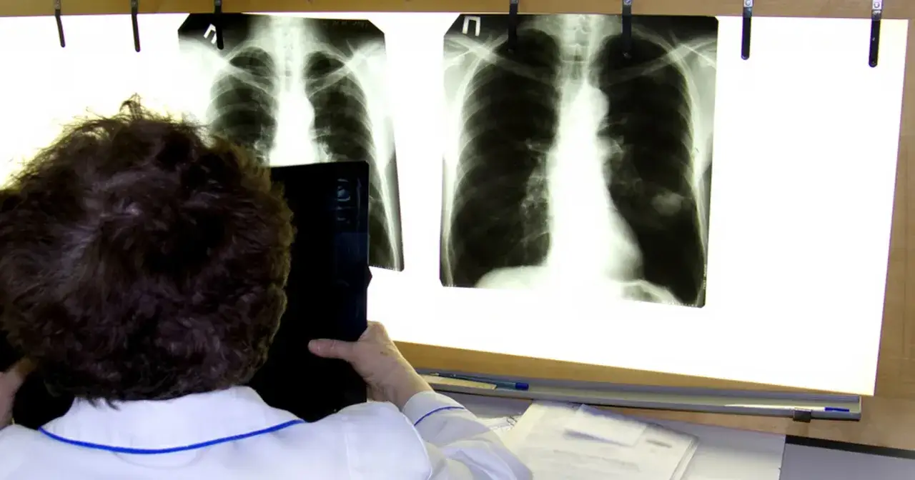 rentgen płuc a tomografia por&oacute;wnanie, diagnostyka raka płuca