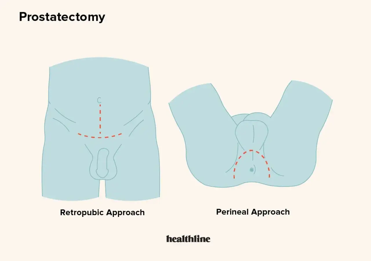 Illustration zeigt zwei chirurgische Ansätze für die Prostataentfernung: retropubisch und perineal.