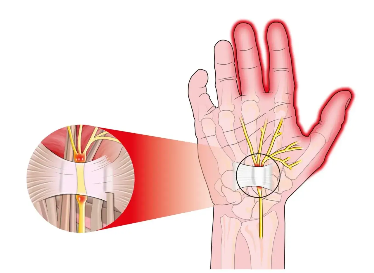 Illustration showing compressed nerves in the wrist, a common cause of numbness in hands while sleeping.