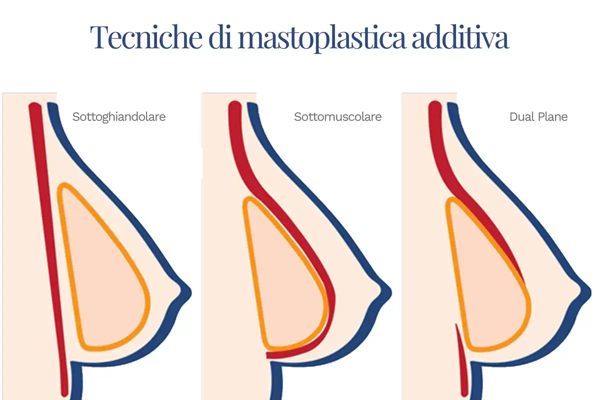 Confronto tecniche mastoplastica: sottoghiandolare, sottomuscolare e Dual Plane. Diverse opinioni sulla migliore per risultati naturali.