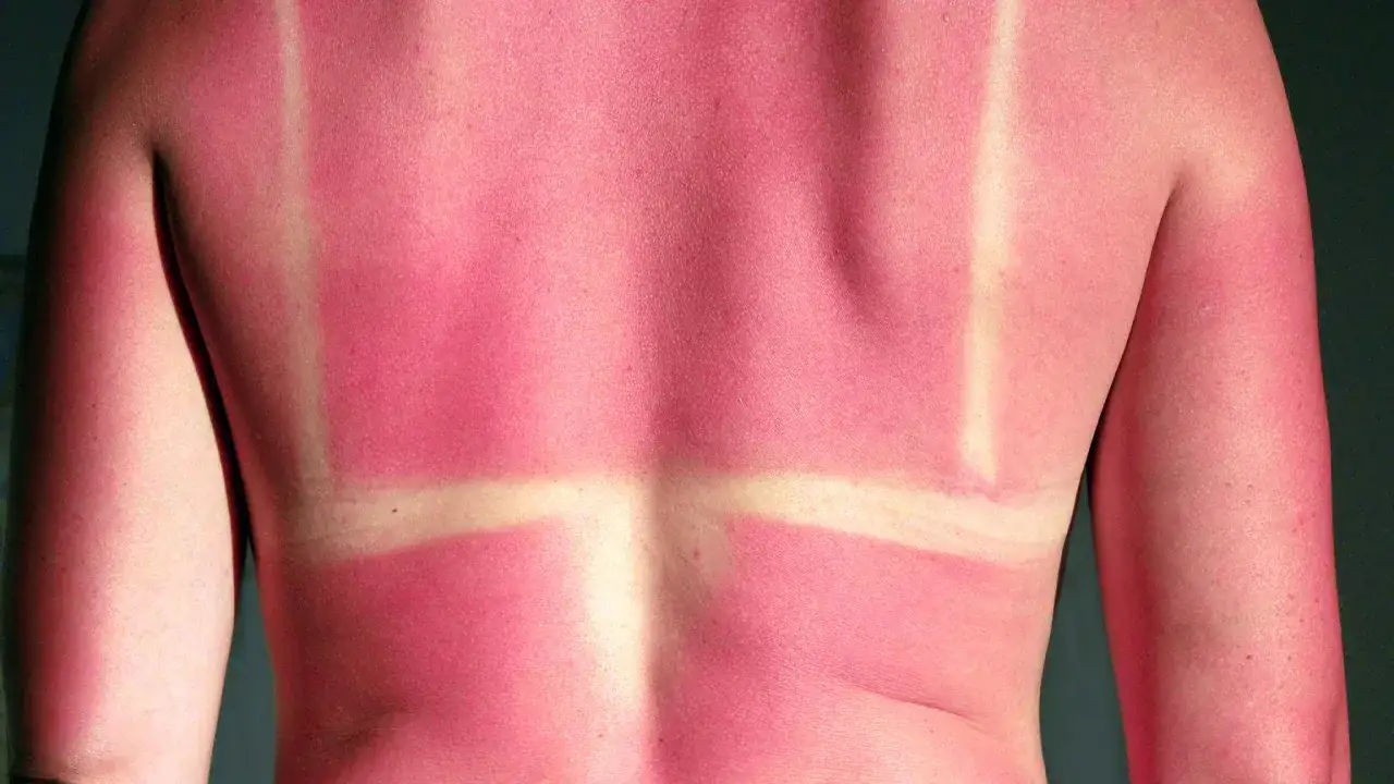 Czerwona skóra pleców po opalaniu z wyraźnymi białymi pasami od stroju kąpielowego.