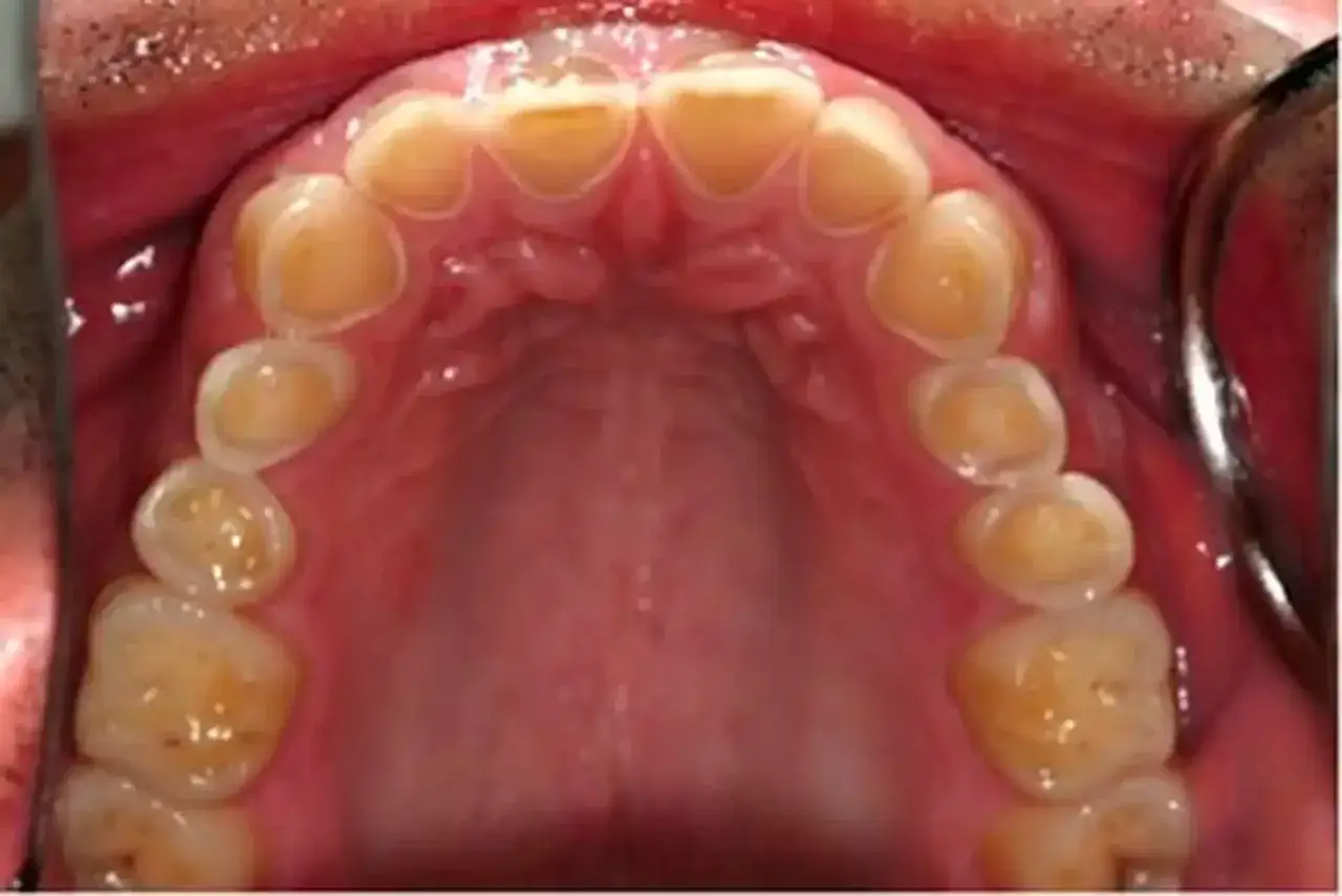 Vista superior de dientes amarillentos y desgastados, con encías inflamadas. Un triste reflejo de los dientes de drogadicto.