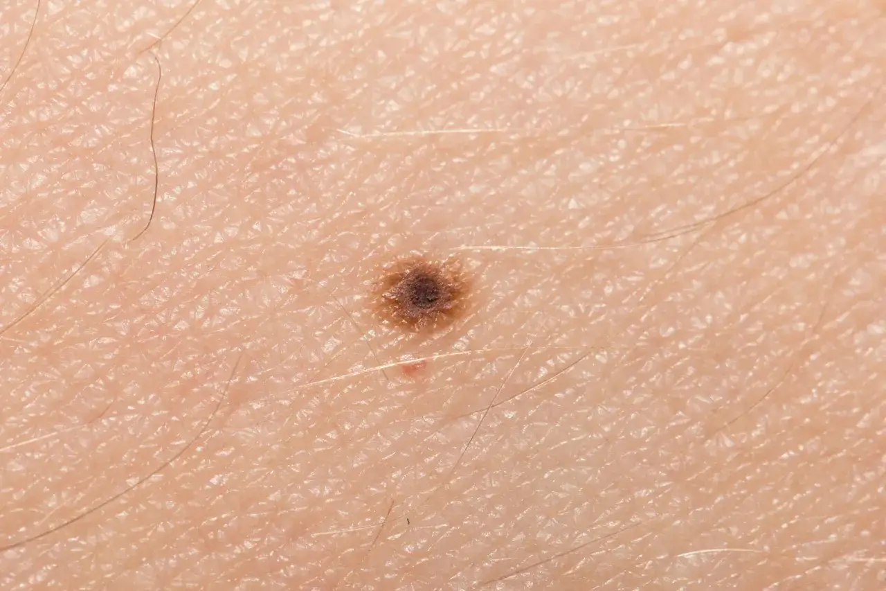 Närbild på hud med en mörk, oregelbunden svart prick i ansiktet, omgiven av fina hårstrån och hudens naturliga textur.