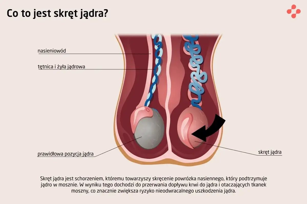 Ilustracja pokazuje skręt jądra, stanowiący zagrożenie dla jego ukrwienia. W przypadku zapalenia jądra leki bez recepty nie są wystarczające.