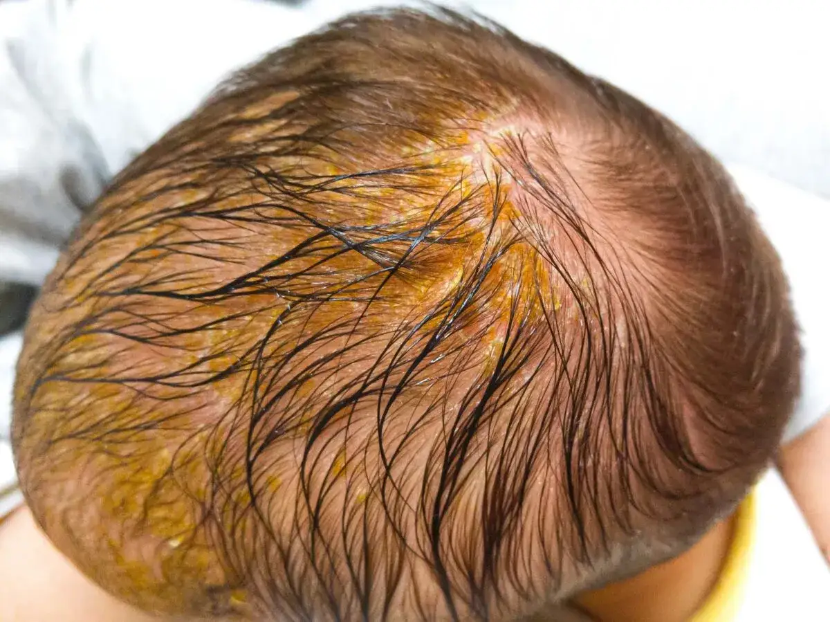 Kopfhaut eines Babys mit gelblichen Schuppen und feinen Haaren. Dies k&ouml;nnte auf Baby-Haarausfall oder Milchschorf hindeuten.