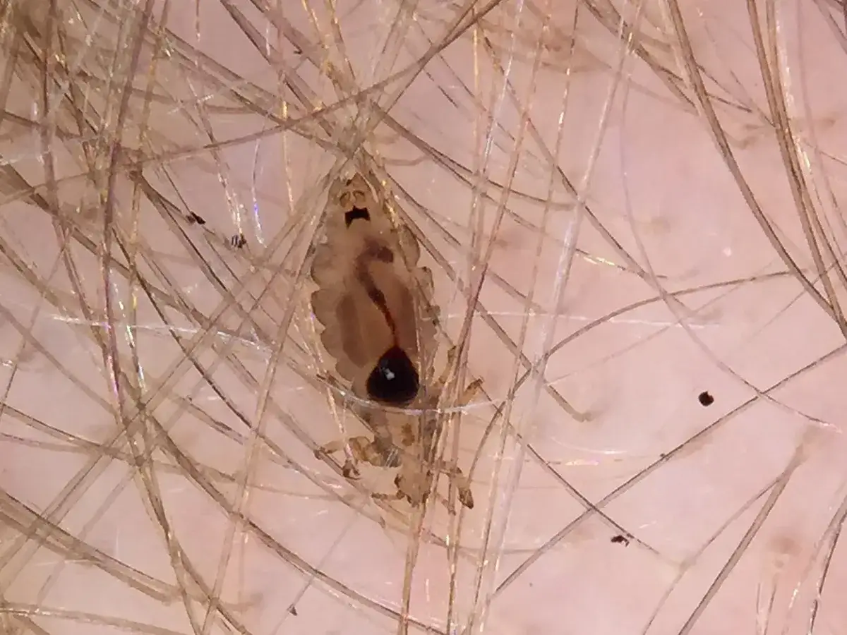 Un piojo adulto se aferra a un cabello. ¿Puede una persona criar piojos? Sí, si no se tratan.