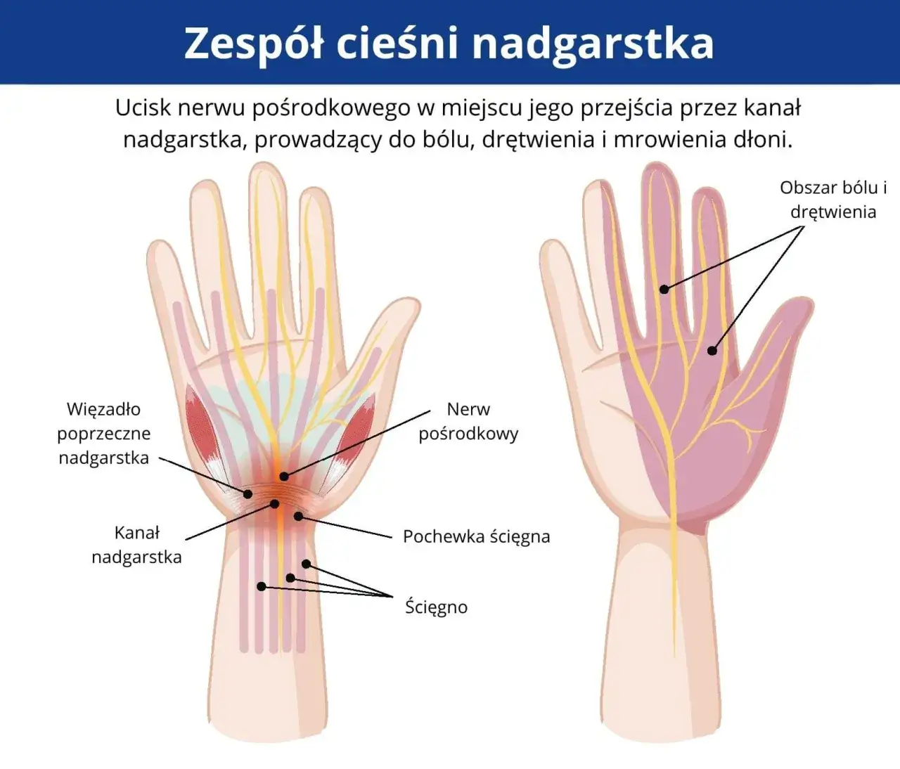 Objawy cieśni nadgarstka mrowienie ręki