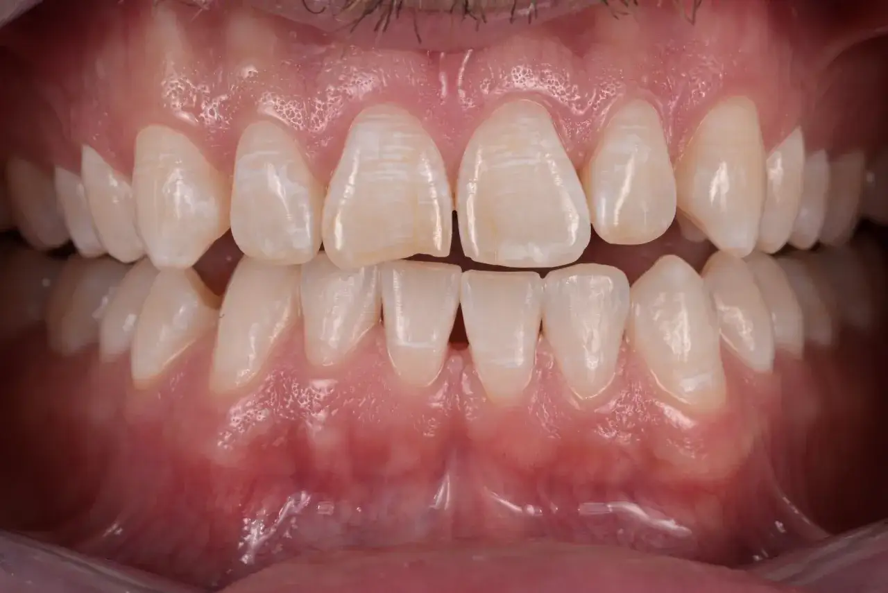 Denti con macchie bianche, forse dovute all'uso di fluoro nei dentifrici. Gengive rosa e sane.