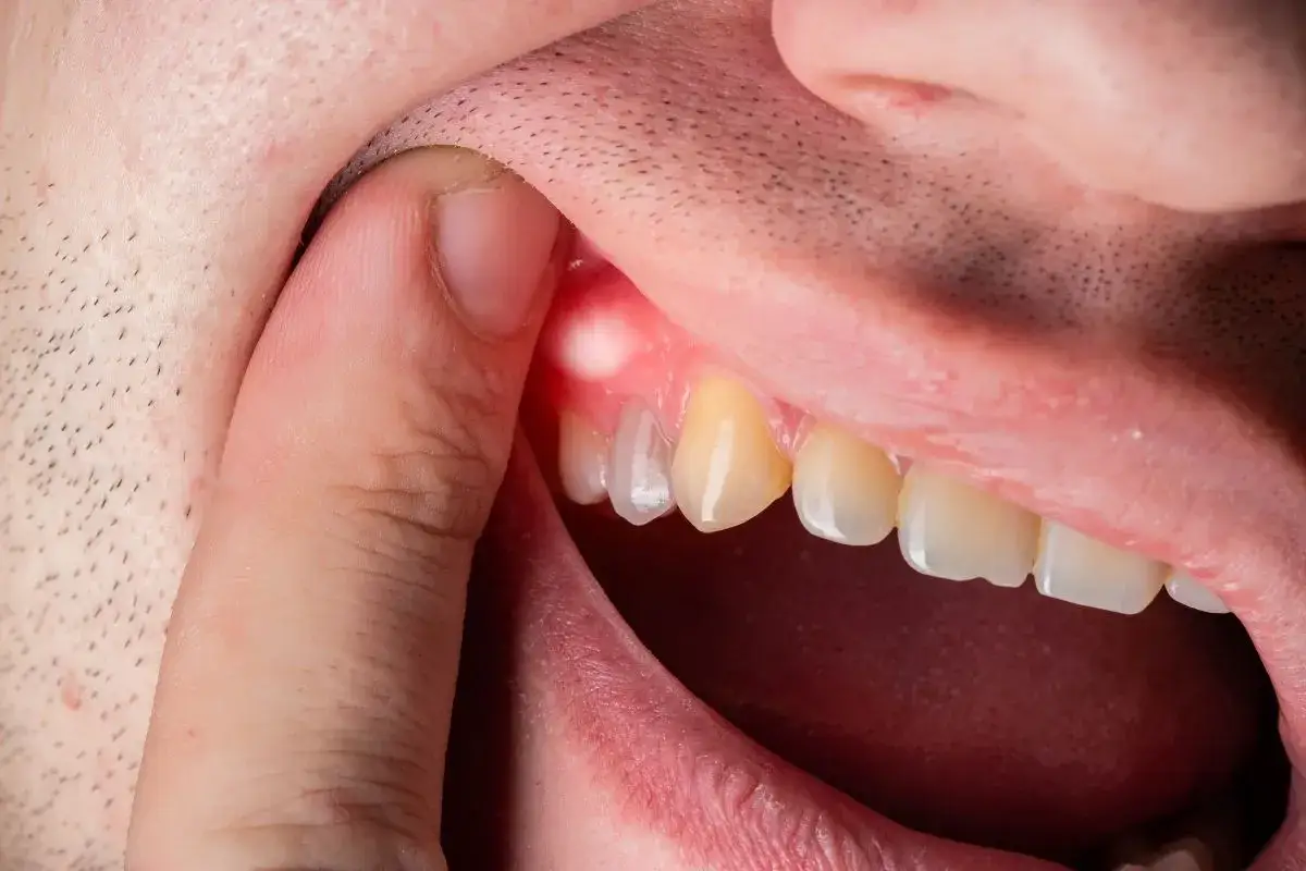 Un dito solleva il labbro mostrando un dente e un piccolo puntino bianco sulla gengiva arrossata, segno di un'infiammazione.