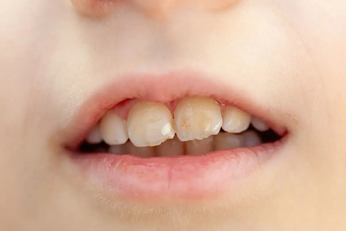 Denti di bambino con macchie bianche e giallastre, segni di ipomineralizzazione dello smalto.