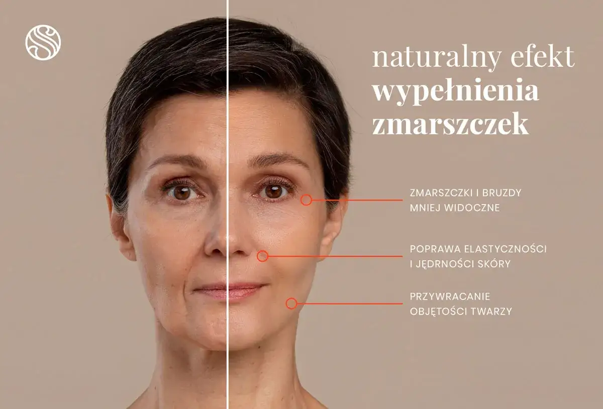 Przed i po zabiegu wypełniania zmarszczek. Skóra odzyskuje jędrność, a rysy twarzy stają się gładsze.