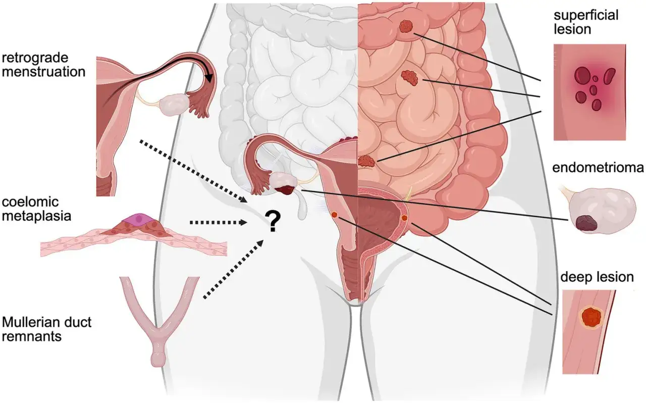 Illustration montrant les origines possibles de l'endom&eacute;triose superficielle, incluant la menstruation r&eacute;trograde, la m&eacute;taplasie c&oelig;lomique et les restes du canal de M&uuml;ller.