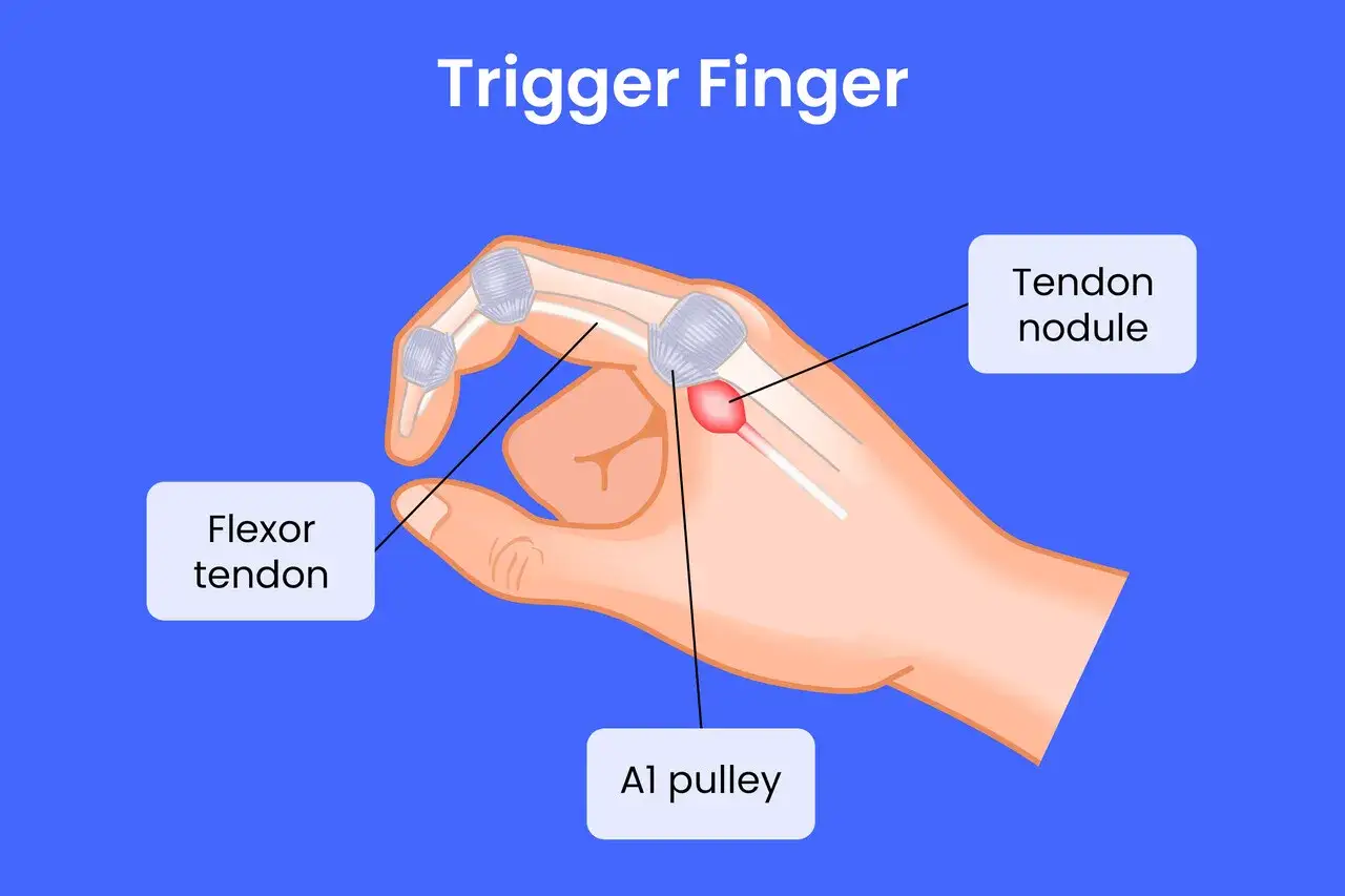 Illustration zeigt, wie ein Sehnenknoten den Flexorsehnen-Gleitweg behindert, was zu Schmerzen beim Beugen des Fingers führt.