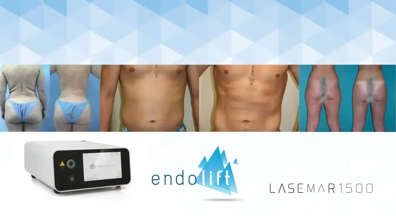 Resultados antes y después de Endolift. Consulta el endolift precio para transformar tu figura.
