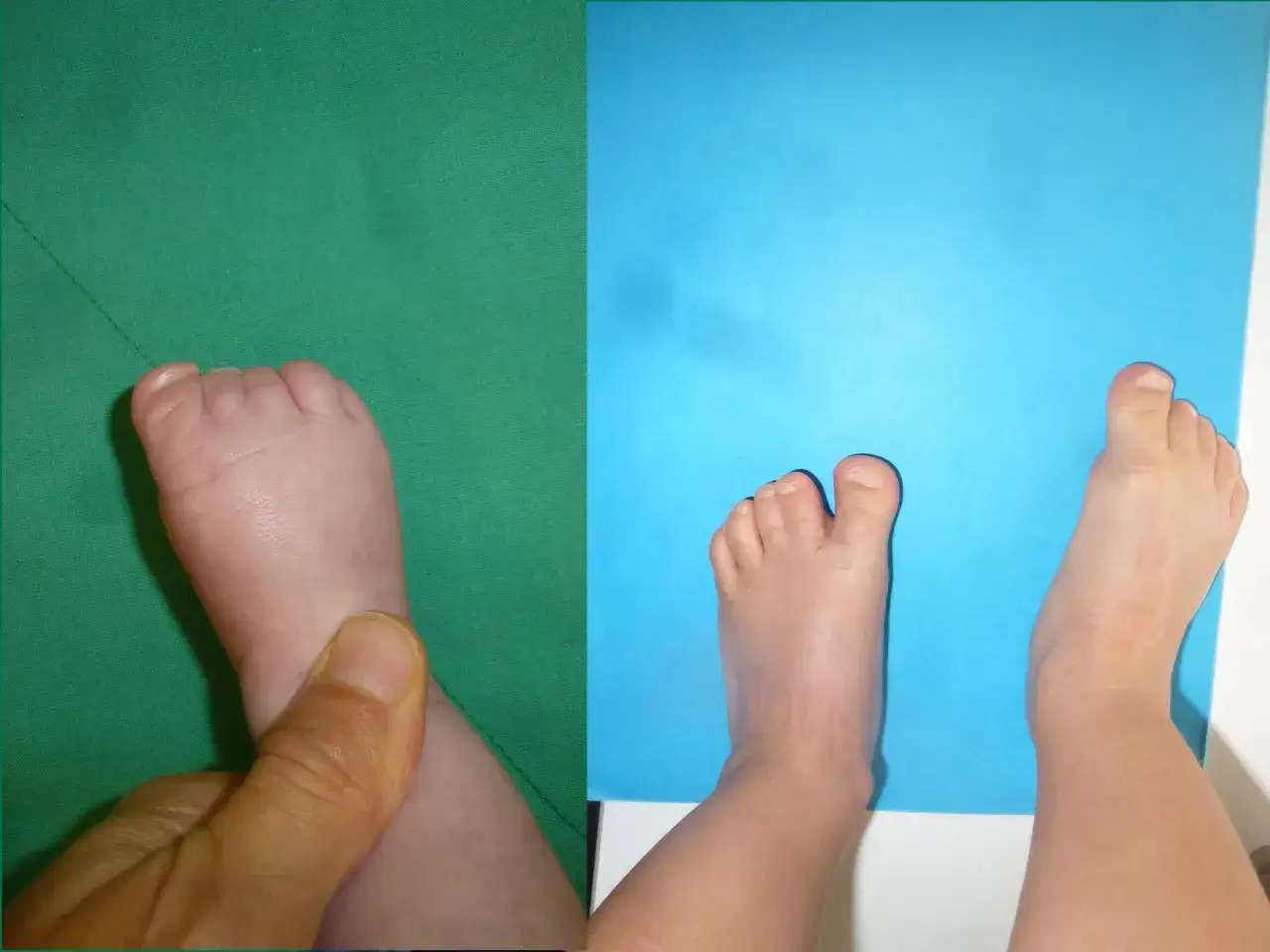 Pied d'enfant pr&eacute;sentant une syndactylie de l'orteil, o&ugrave; les orteils sont fusionn&eacute;s.