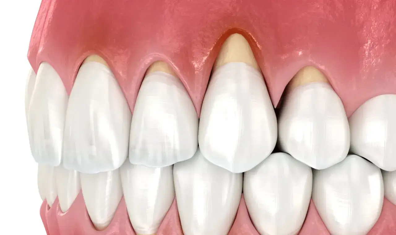 Denti con gengive infiammate e arrossate. La recessione gengivale &egrave; visibile, con la radice del dente esposta. Preoccuparsi &egrave; necessario se si notano questi segni.