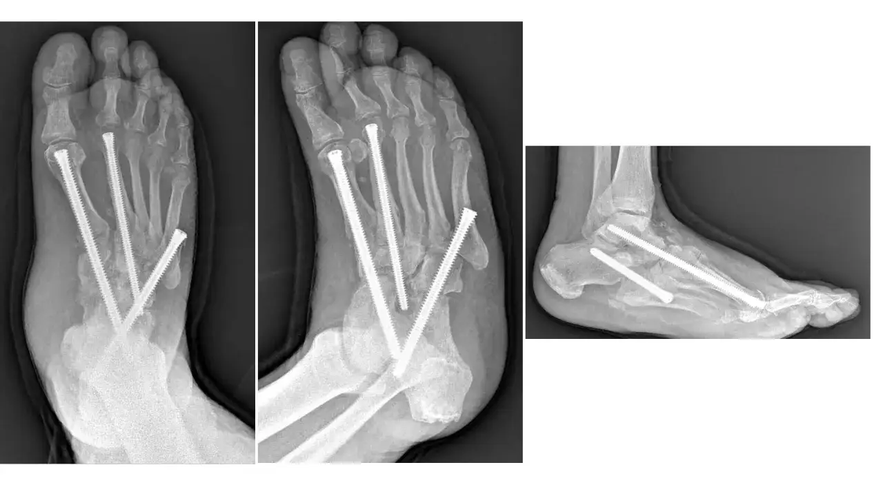 Radiografie di un piede Charcot con viti metalliche che stabilizzano le ossa fratturate.