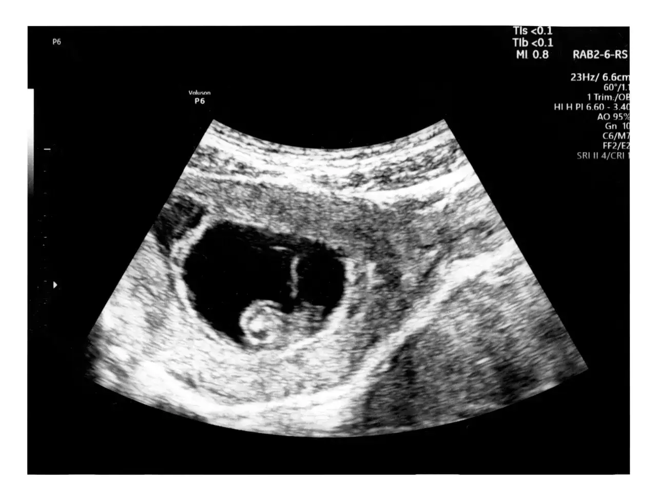 Ultraschallbild zeigt, wie kleine babys im bauch schlafen. Man sieht die fr&uuml;he Entwicklung im Mutterleib.