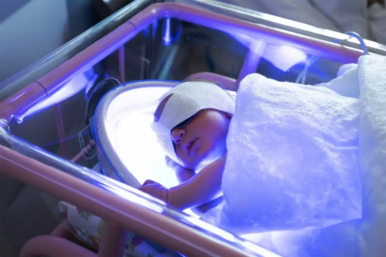 Neonato sotto lampada per fototerapia, trattato per ittero. Occhi coperti, avvolto in una coperta bianca.
