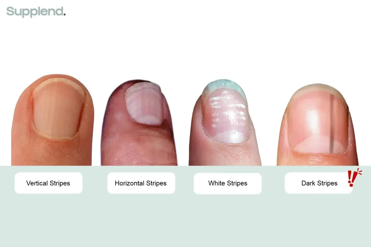 Cuatro u&ntilde;as muestran diferentes tipos de estr&iacute;as: verticales, horizontales, blancas y oscuras.