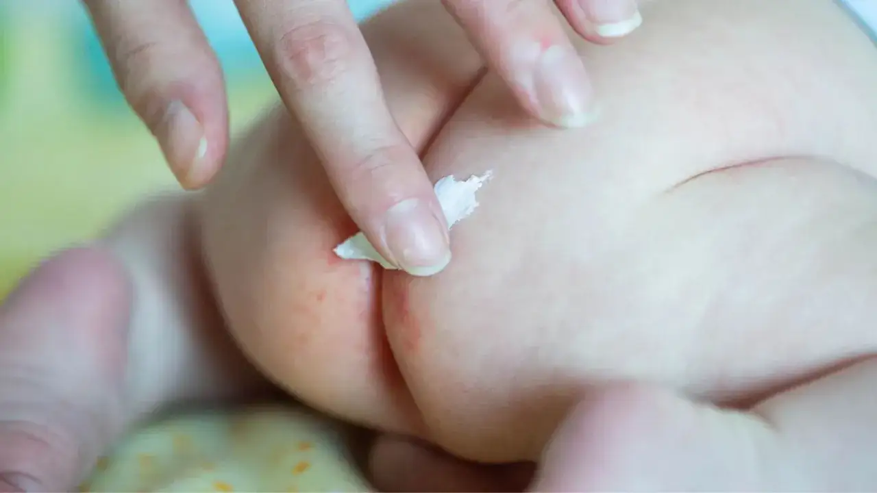 Mano applica crema su piaghe culetto neonato. Come curarla? La pelle arrossata richiede attenzione e cura.