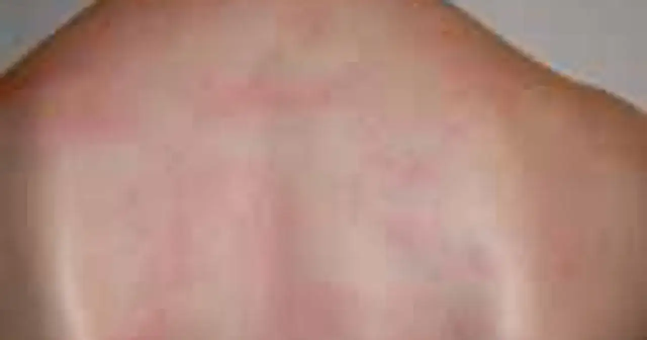 Czerwona wysypka na plecach, być może reakcja na lek Doreta 75 mg + 650 mg.