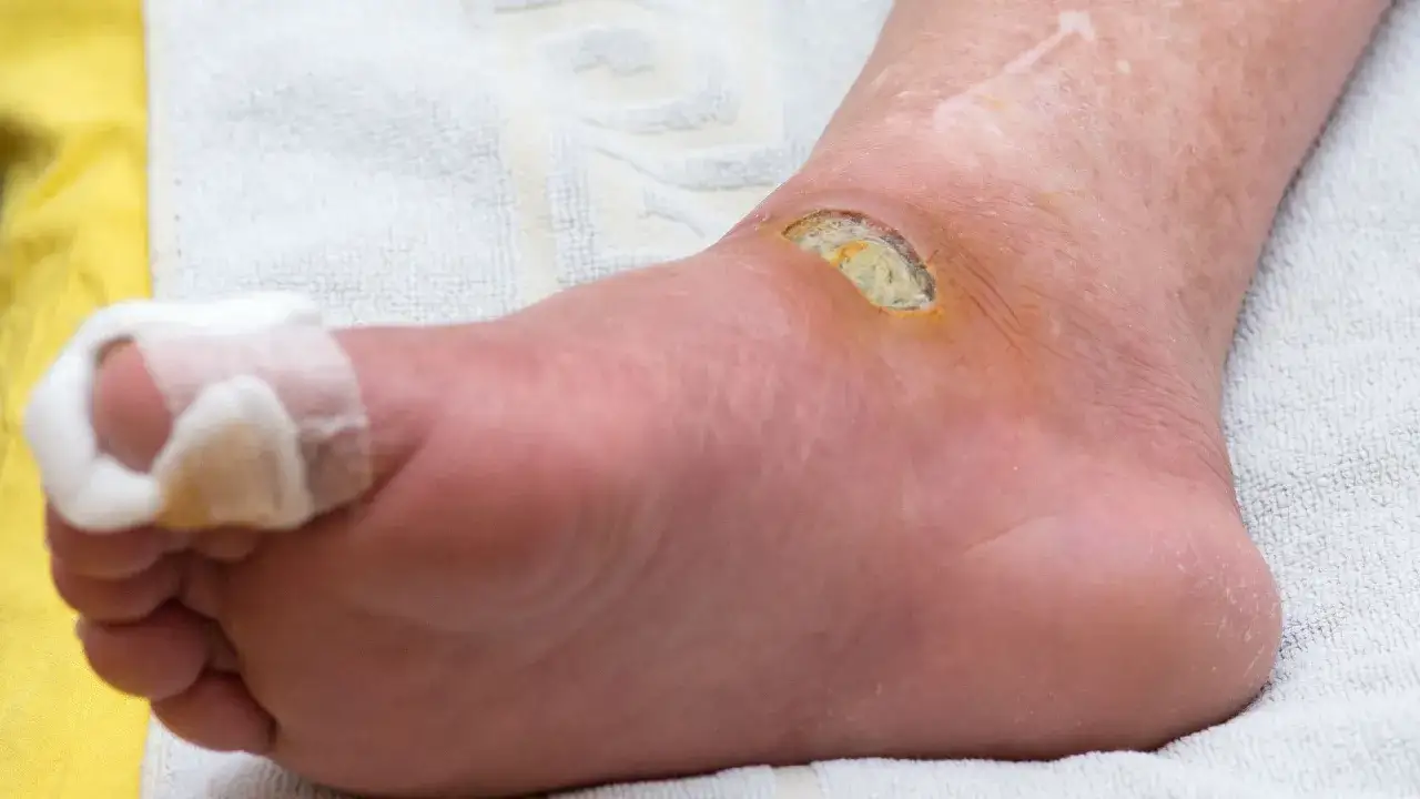 Stopa z raną na kostce, objaw neuropatii cukrzycowej. Palec owinięty bandażem.