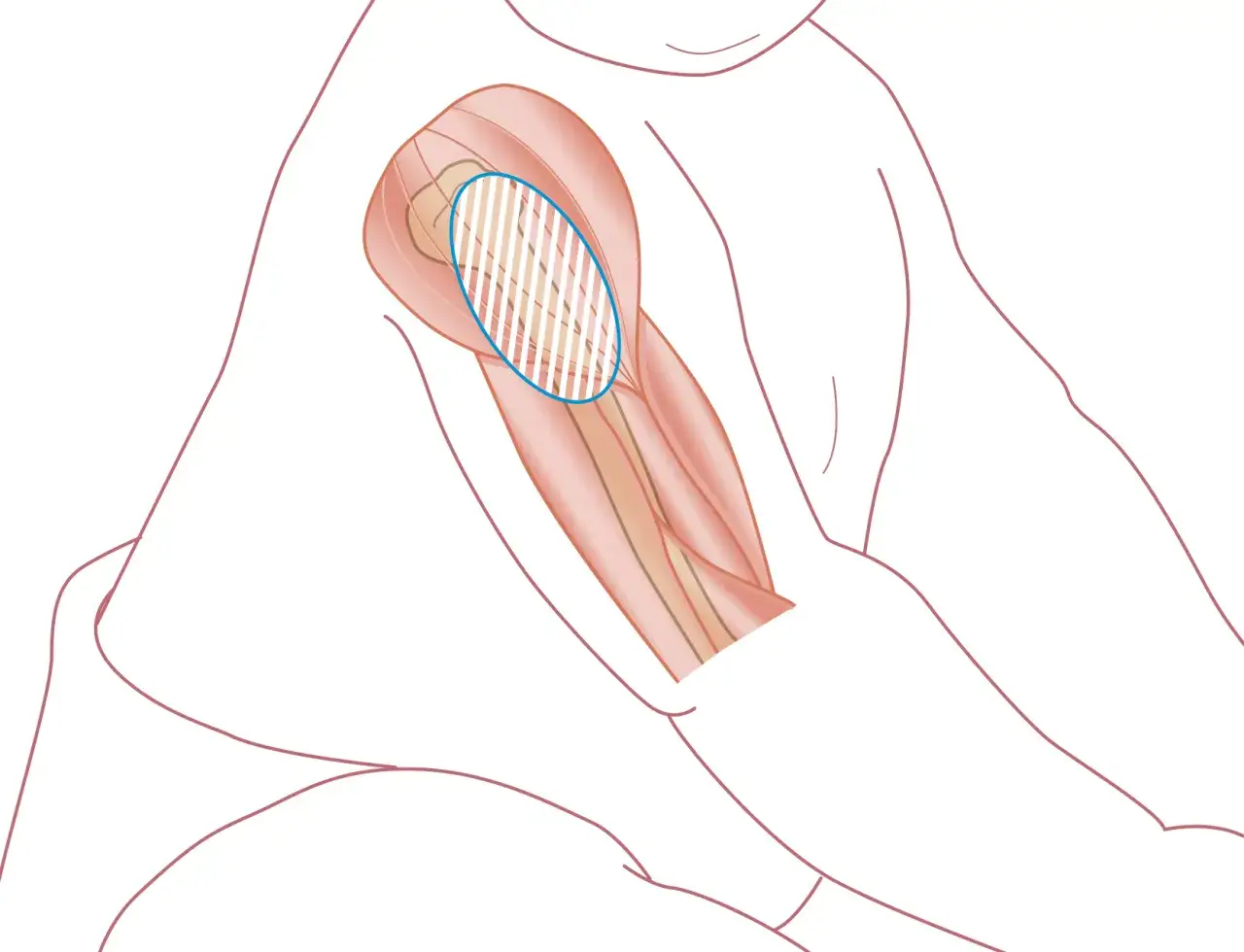 Illustration av en arm med markerad muskel d&auml;r det kan k&auml;nnas ont i armen efter tbe vaccination.
