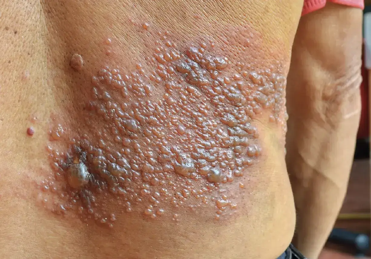 Eruzione cutanea con vescicole su un fianco, possibile sintomo di nevralgia post erpetica. Si cercano rimedi naturali.