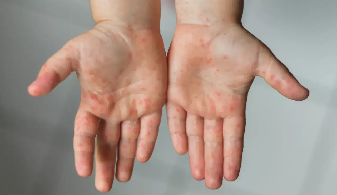 Mains d'un enfant couvertes de petites éruptions rouges, typiques du pied-main-bouche adulte.