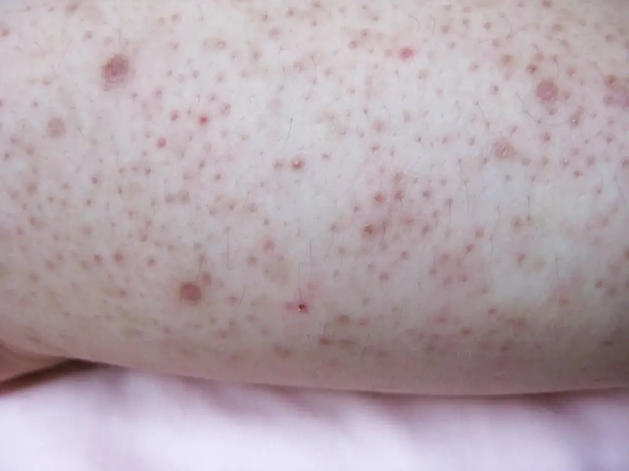 Piel con peque&ntilde;as protuberancias rojas y oscuras, similar a las 