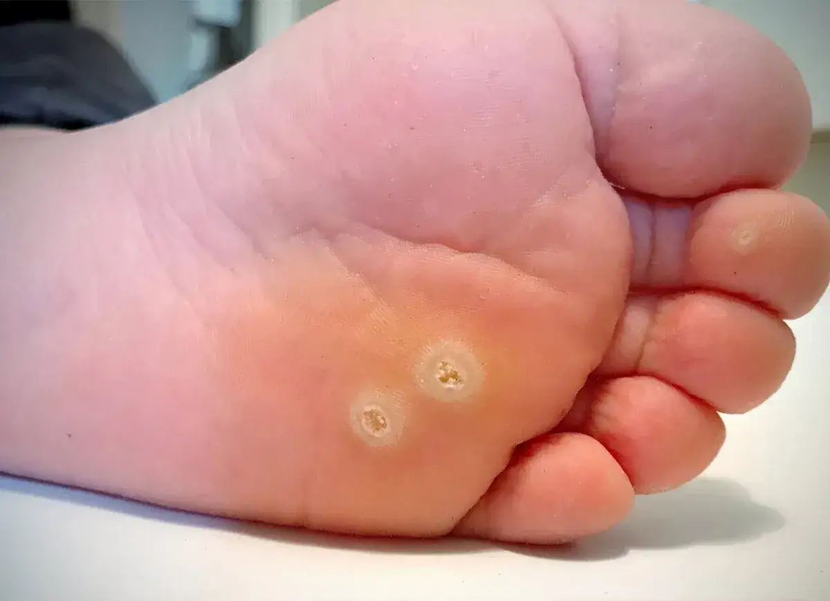 Gros plan sur la plante d'un pied, montrant deux verrues bien visibles pr&egrave;s des orteils.