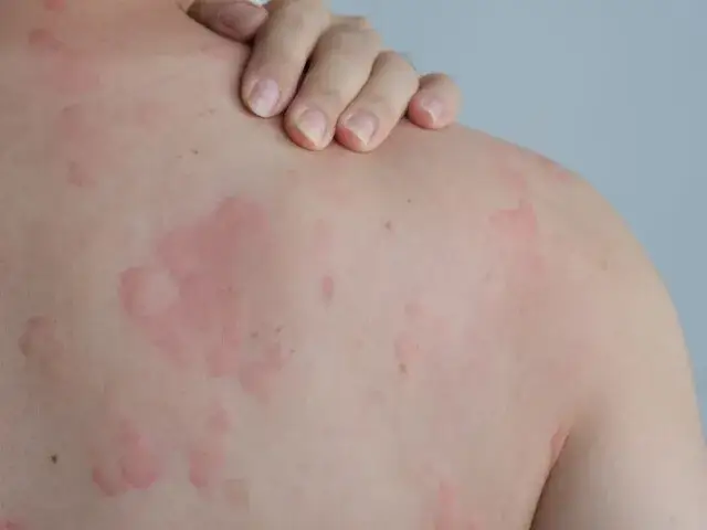 pokrzywka alergiczna