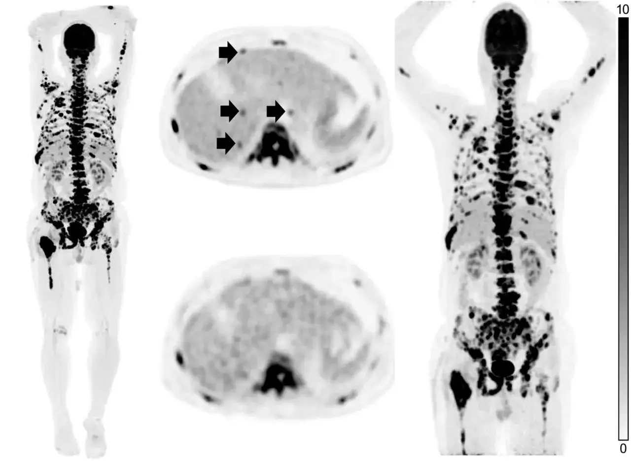 PET/CT zeigt viele L&auml;sionen im K&ouml;rper. Die Pfeile deuten auf L&auml;sionen in der Leber hin, was ein Nachteil der Methode sein kann, wenn sie nicht richtig interpretiert wird.