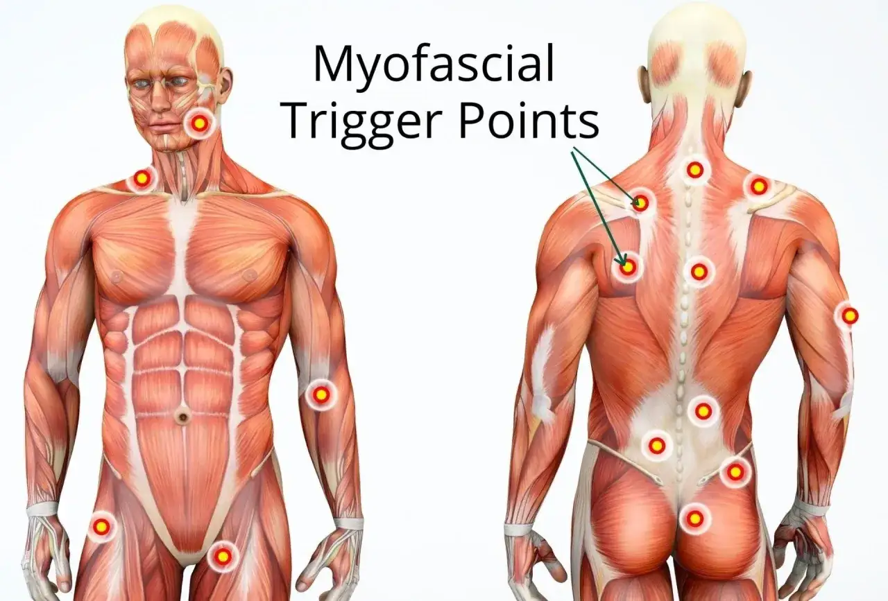 Anatomie montrant des points g&acirc;chettes myofasciaux sur le corps humain, indiquant des zones de tension musculaire.