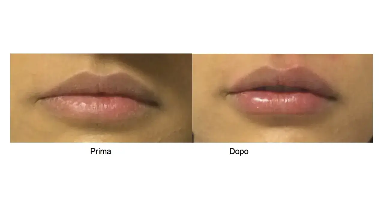 Prima e dopo: labbra pi&ugrave; piene e definite grazie a un filler labbra naturale.