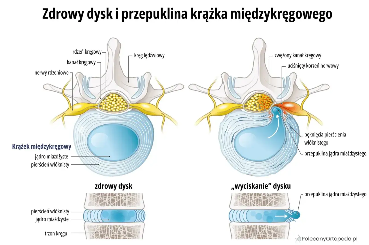 Zdrowy dysk vs. przepuklina. Obrazek pokazuje, jak przepuklina jądra miażdżystego uciska korzeń nerwowy, co może prowadzić do radikulopatii.